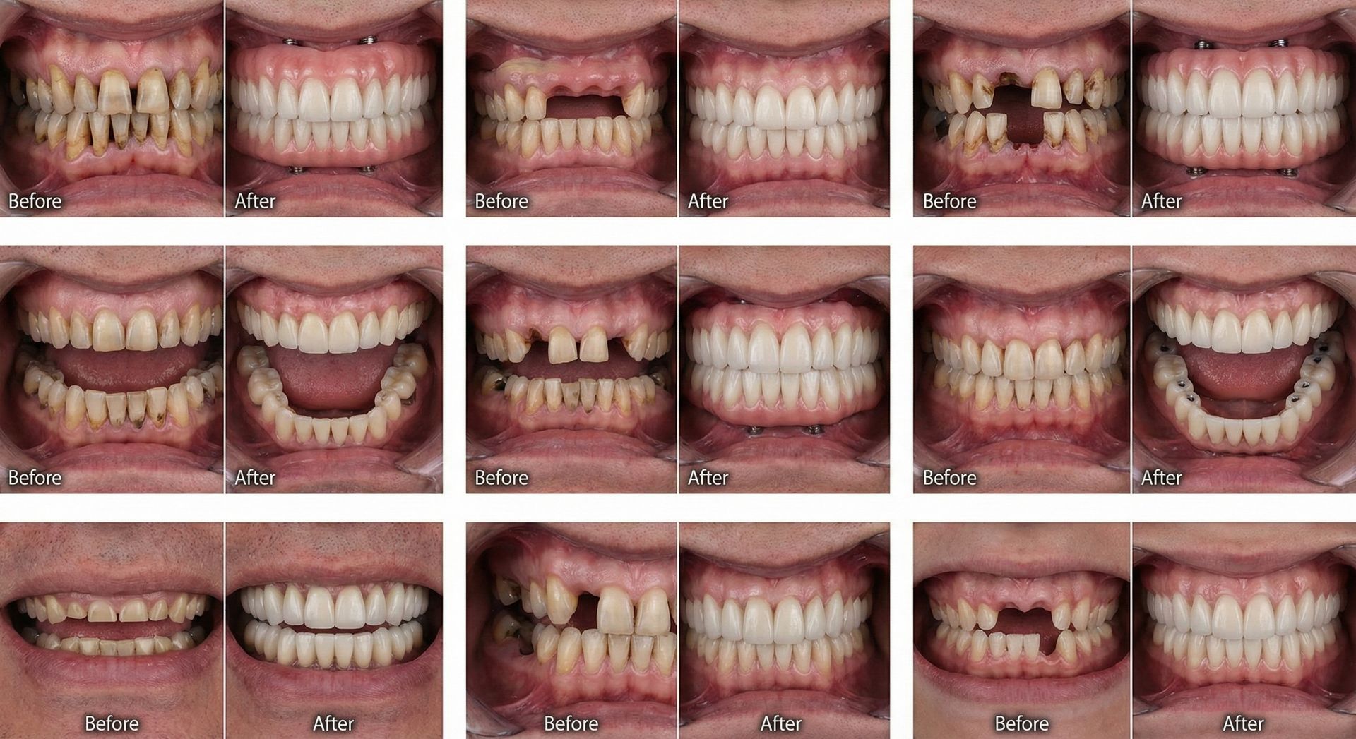 Full Arch Dental Implants Before and After - 8 Patient Cases at Deluxe Dentistry Hamilton NJ