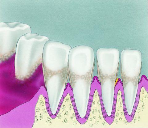Robbinsville-new-jersey-nj-perio-periodontics-gingivitis, Periodontitisis-dentist-dentists-gum-disease-deep-root-scaling