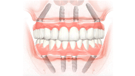 All-on-4-All-on-6-Full-Arch-Dental-Implants-Ewing, NJ-Dentist