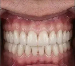 After full arch dental implants: complete upper and lower arches of new, even teeth fixed to implants