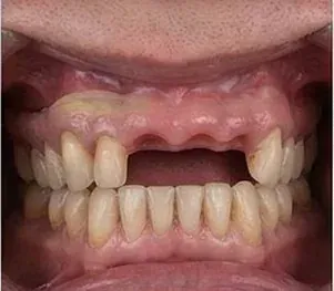 Before full arch dental implants: four missing upper front teeth and worn, uneven teeth in both jaws