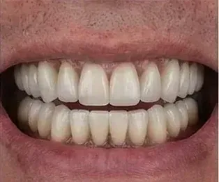 After full arch dental implants: upper and lower arches of even, white fixed teeth