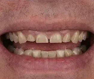 Before full arch dental implants: worn, chipped and yellowed upper and lower teeth
