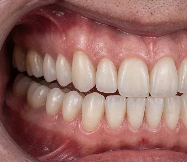After All-on-4 dental implants: the upper arch restored with an even row of white fixed teeth, anticipated result