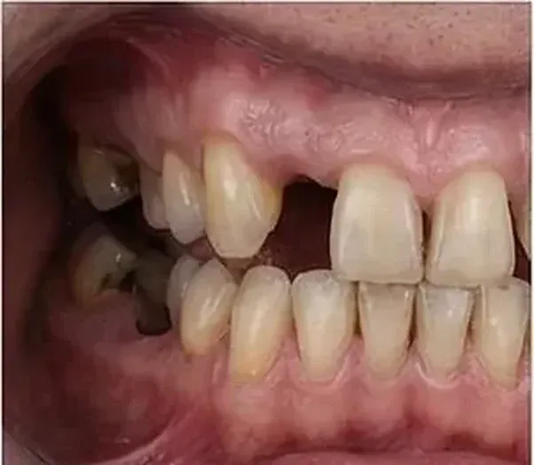 Before All-on-4 dental implants: missing, decayed and stained upper teeth above worn lower teeth