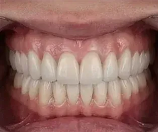 After full arch dental implants: a full, even smile with every tooth replaced