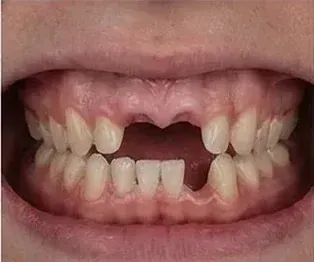 Before full arch dental implants: missing upper front teeth and a gap in the lower front teeth