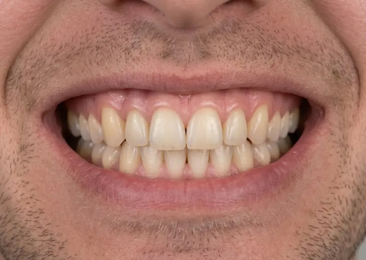 The same smile with the gap filled by a fixed dental bridge, anticipated result