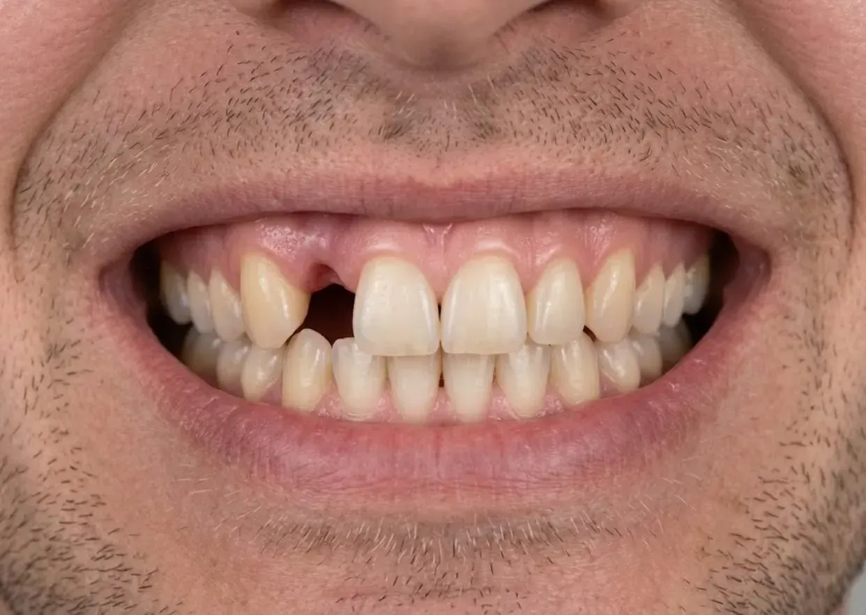 Smile with a gap where a front tooth is missing, before a dental bridge