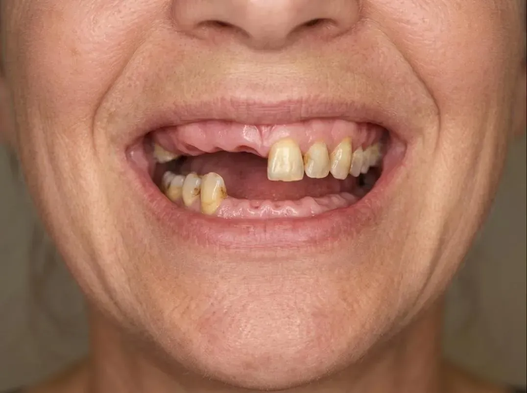 Smile with several missing and failing teeth before dentures