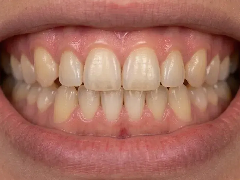 After Fastbraces: the gaps closed and the upper teeth in an even line, anticipated result