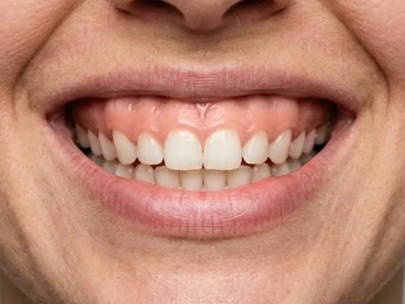 Gummy smile with too much gum showing before gum contouring in a smile makeover