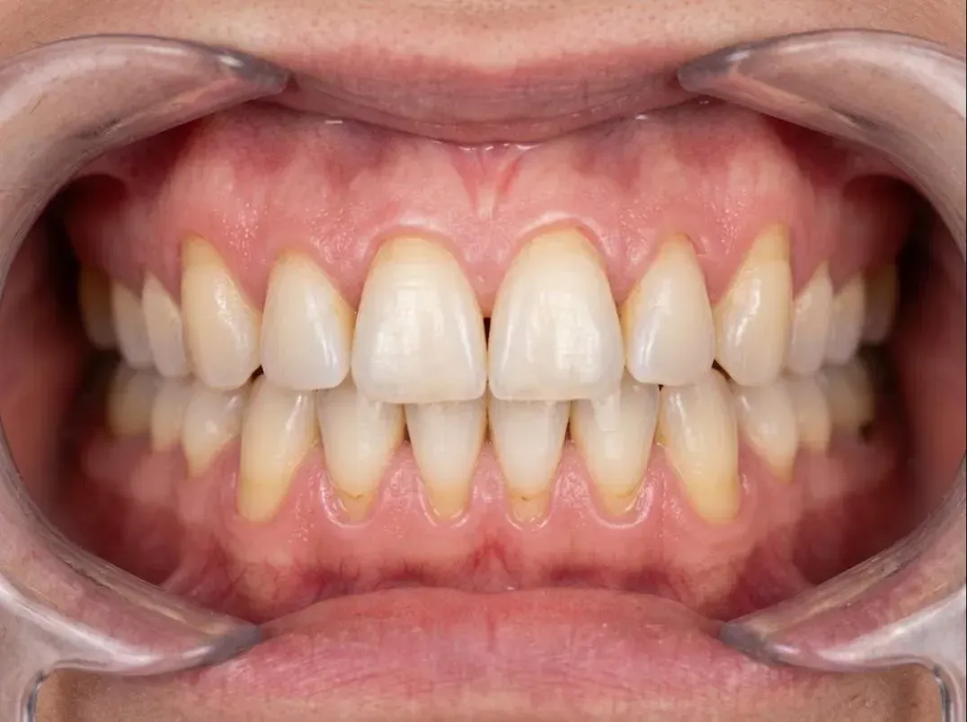 Before gum grafting: receding gums leaving the lower teeth looking long