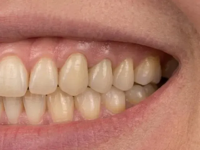 The same smile with the gap closed by a fixed implant bridge, anticipated result