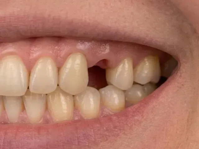 Smile with a gap in the upper side teeth before an implant bridge