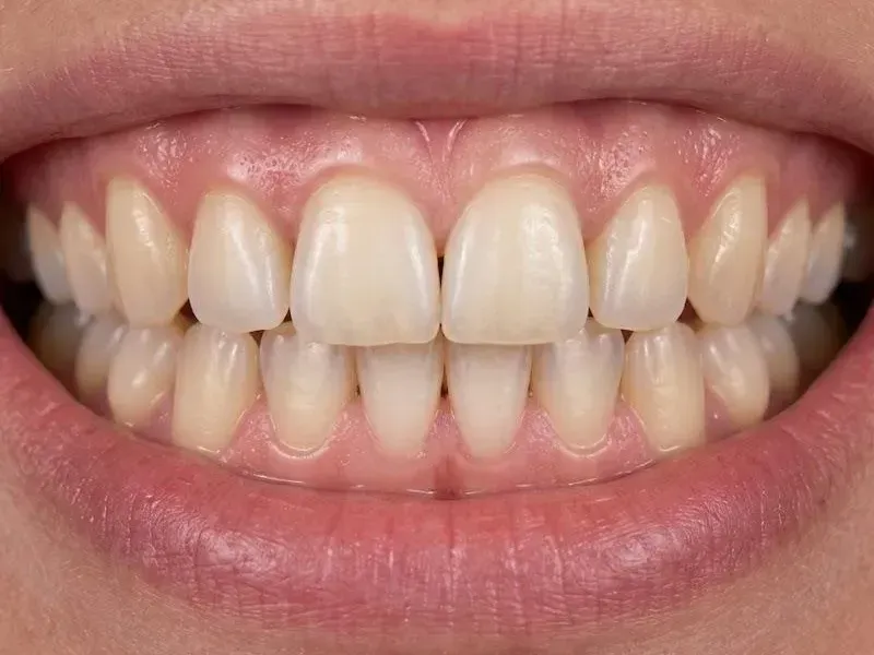 After Invisalign: close-up smile with the front-tooth gap closed and the turned tooth straightened by clear aligners