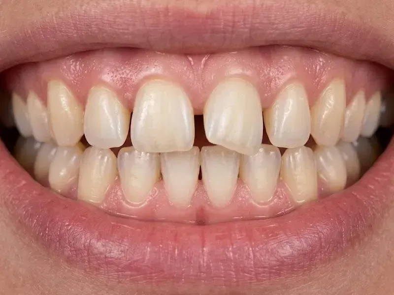 Before Invisalign: close-up smile with a gap between the front teeth and a turned front tooth