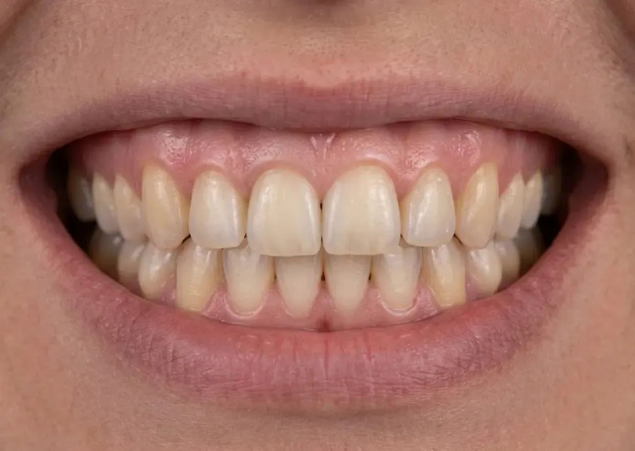 After: anticipated result of a single dental implant and crown placed once the preserved socket healed
