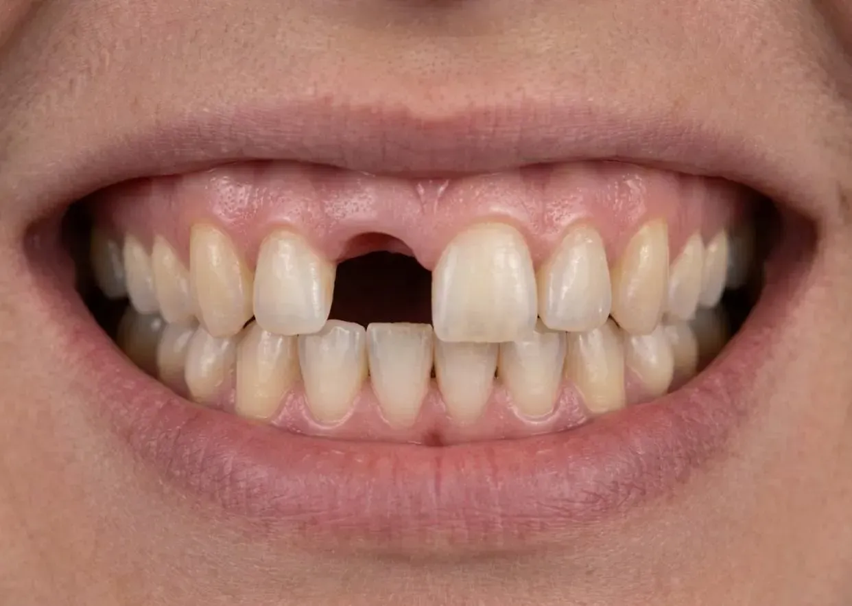 Before: smile with an upper front tooth missing, the gap a socket graft keeps ready for a dental implant
