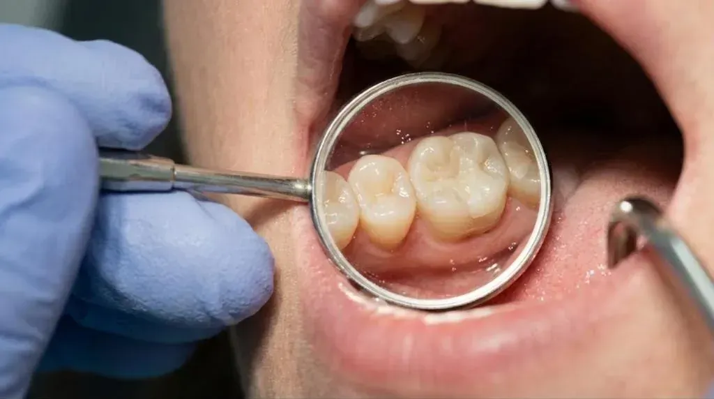 Tooth-Colored Fillings: dental mirror showing a tooth-colored filling on a back tooth