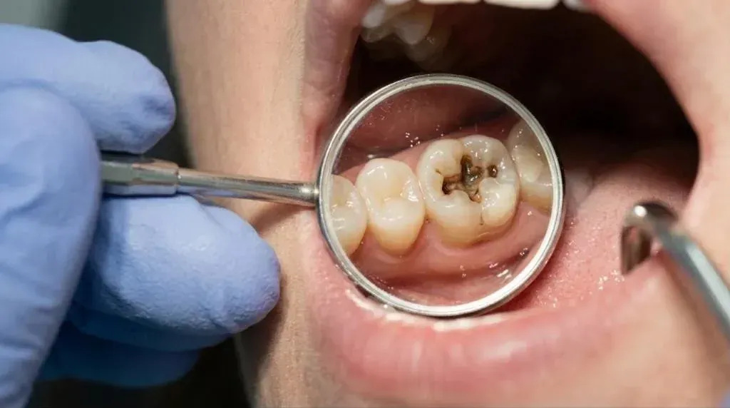 Dental mirror showing a dark cavity in a back tooth before a tooth-colored filling