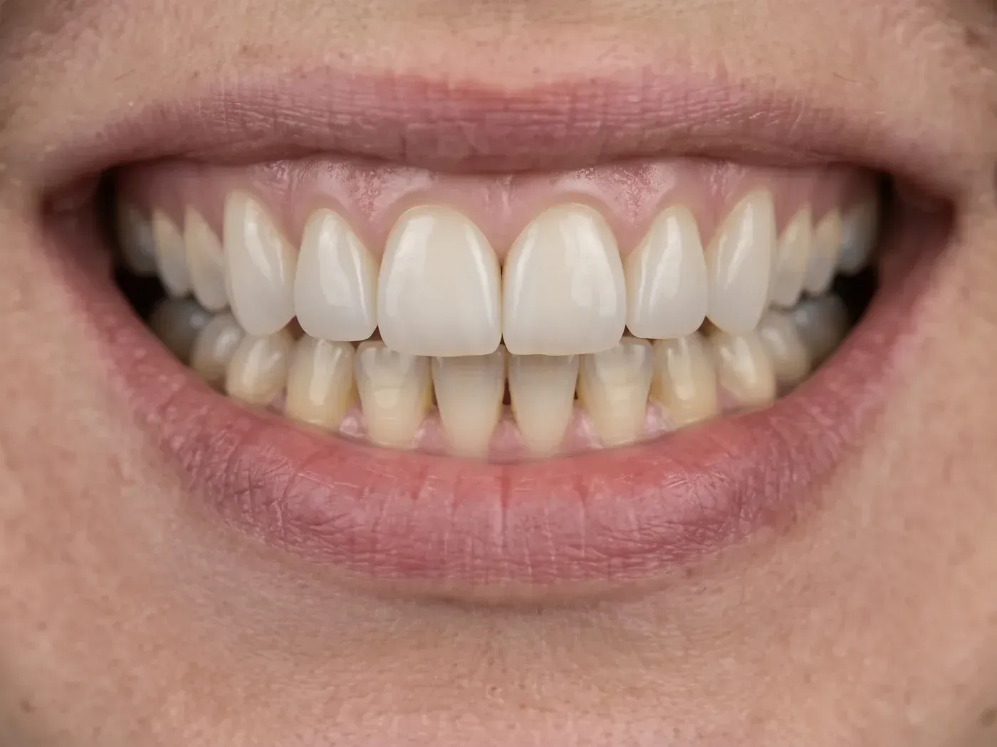 Bright, even upper teeth with porcelain veneers in a smile makeover