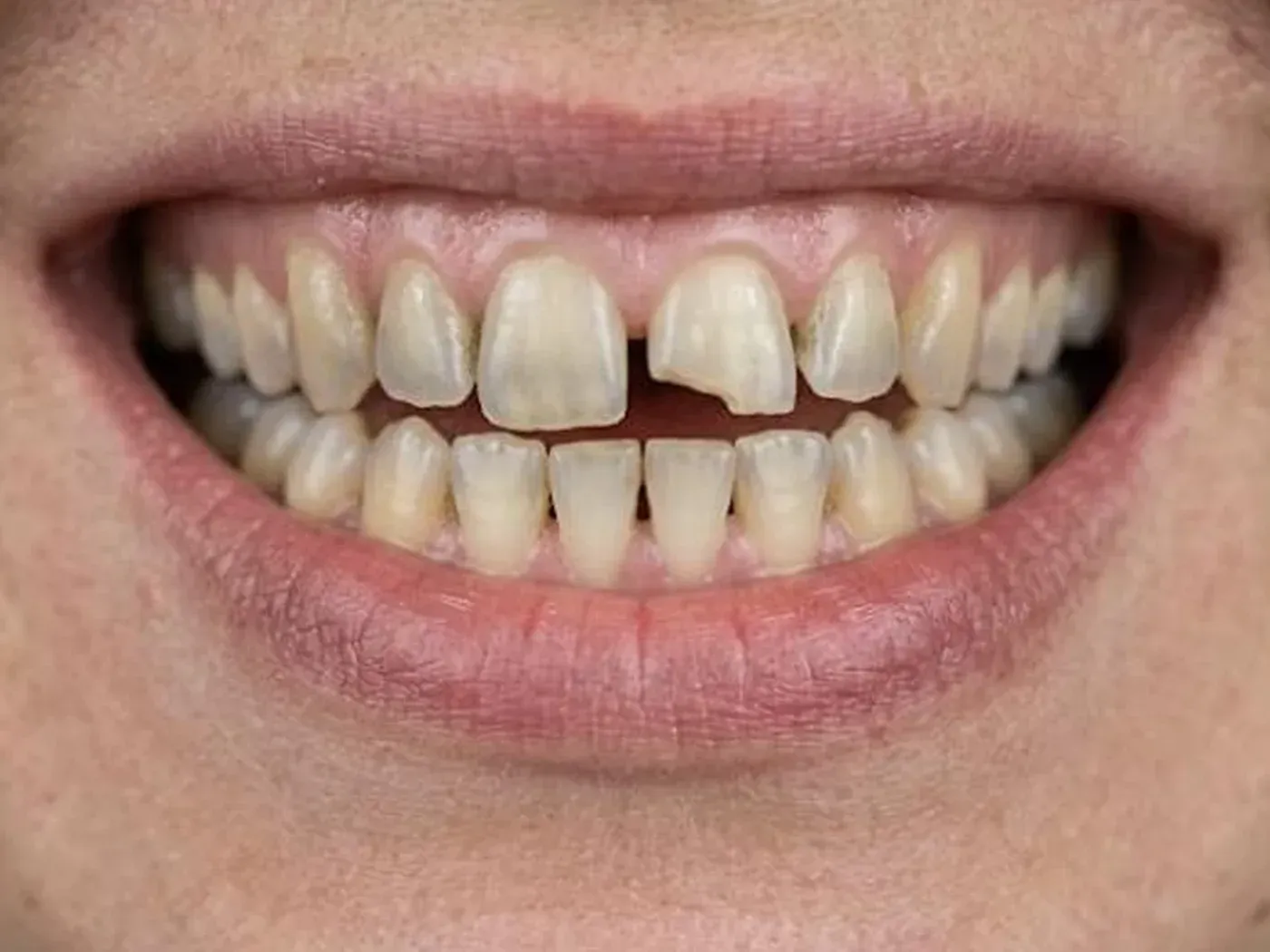 Chipped, stained upper front teeth before porcelain veneers in a smile makeover