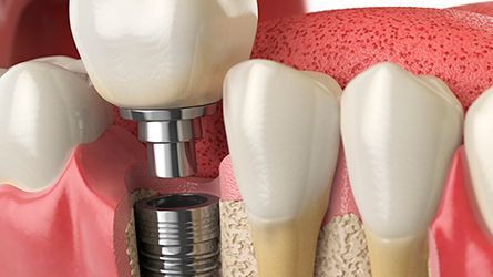 Bone-Grafting-Ewing, NJ-Dentist