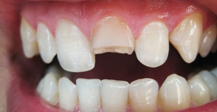 Chipped and broken tooth emergency repair at Deluxe Dentistry for Hamilton NJ patients