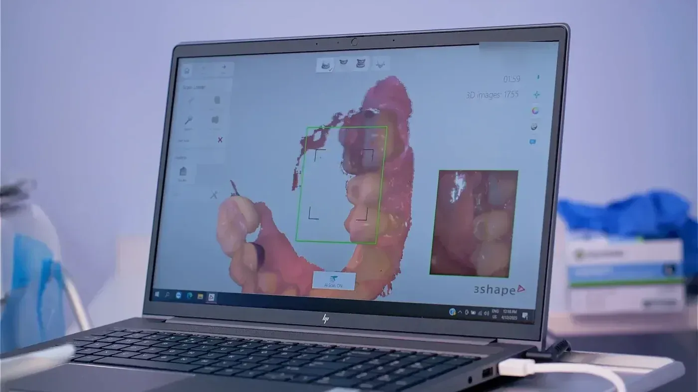 Laptop showing a digital 3D scan of a patient’s teeth, the digital impression used to plan an implant bridge
