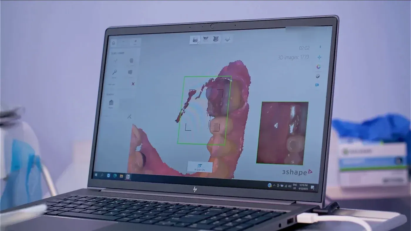 A live 3D intraoral scan of the teeth on a laptop, used when planning a socket preservation graft after a tooth extraction