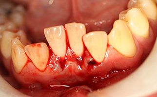 Dental trauma and facial injury emergency care at Deluxe Dentistry for Hamilton NJ residents