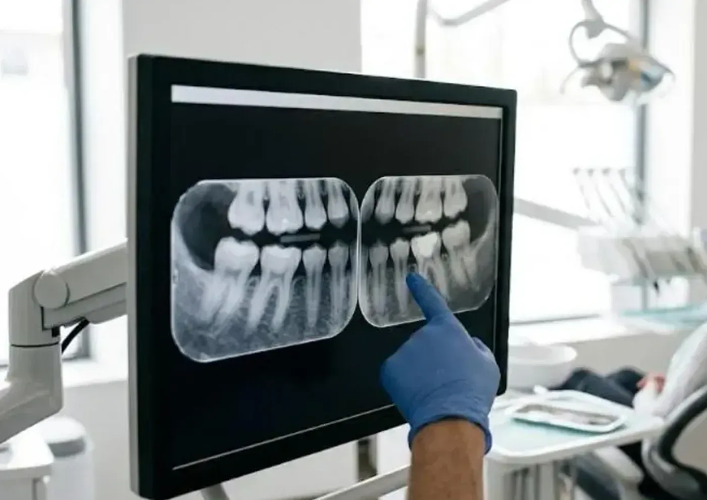 Dental X-Rays: digital bitewing X-rays on a chairside monitor, with a gloved hand pointing to a tooth