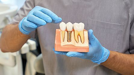Single-Dental-Implants-Implant-Bridges-Ewing, NJ-Dentist