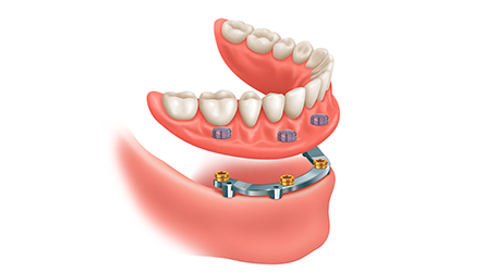 Dental-Implant-Supported-Dentures-Ewing, NJ-Dentist
