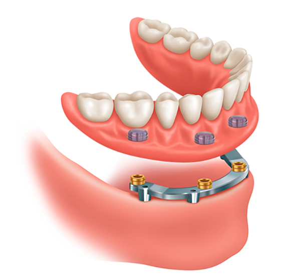 implants supported dentures