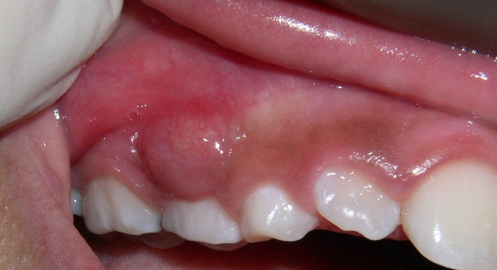 Dental infection and abscess emergency treatment at Deluxe Dentistry near Hamilton NJ