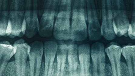 Internal-Sinus-Lifts-Ewing, NJ