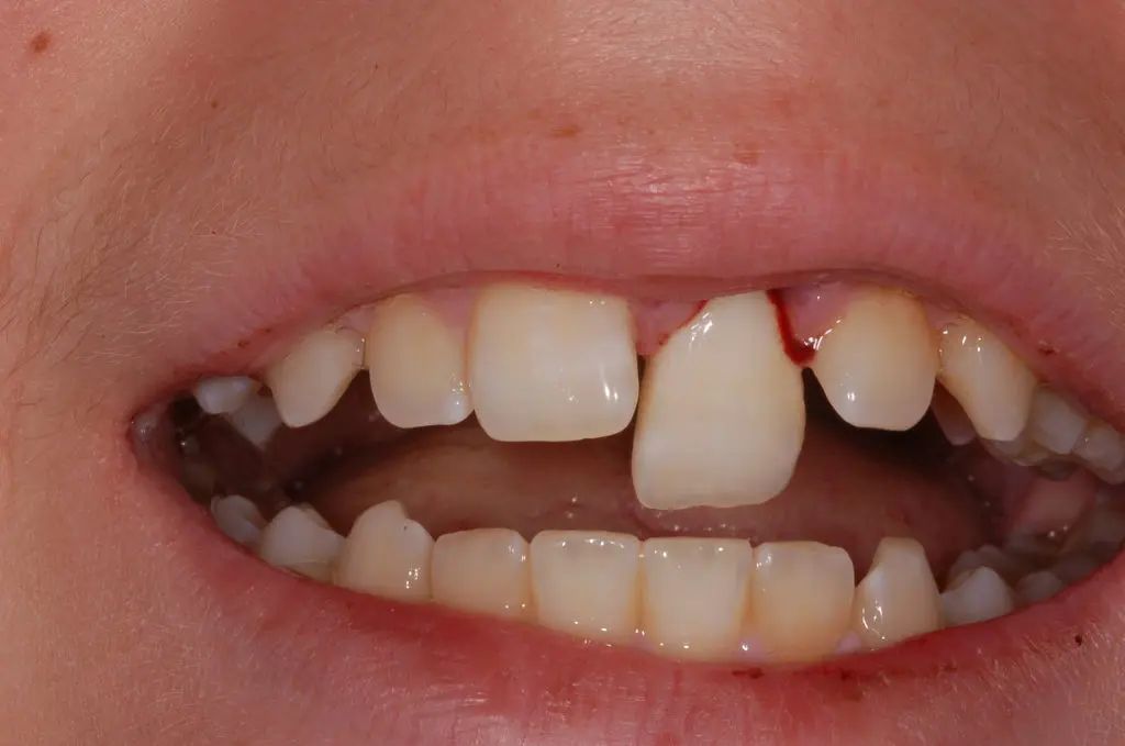 Emergency treatment for a knocked-out tooth at Deluxe Dentistry serving Hamilton Township NJ