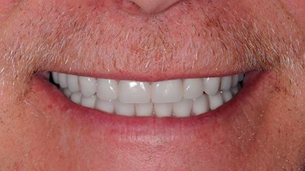 Full-Mouth-Reconstruction-Ewing, NJ-Dental Implant-Dentist