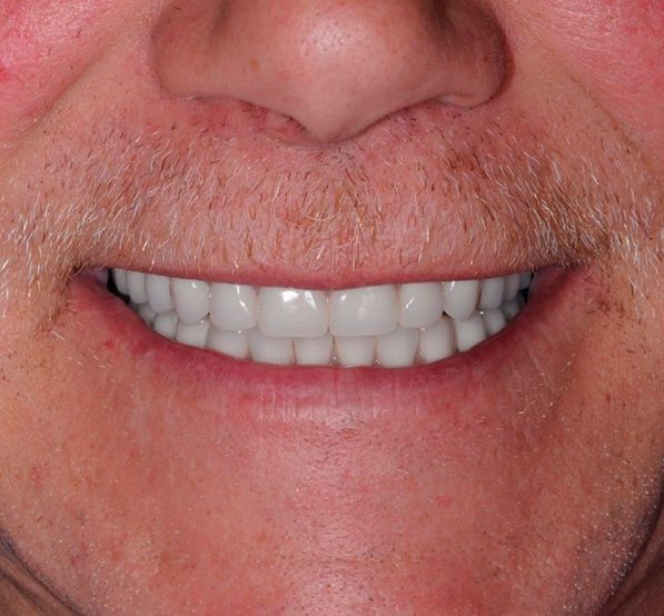 Full Mouth Reconstruction