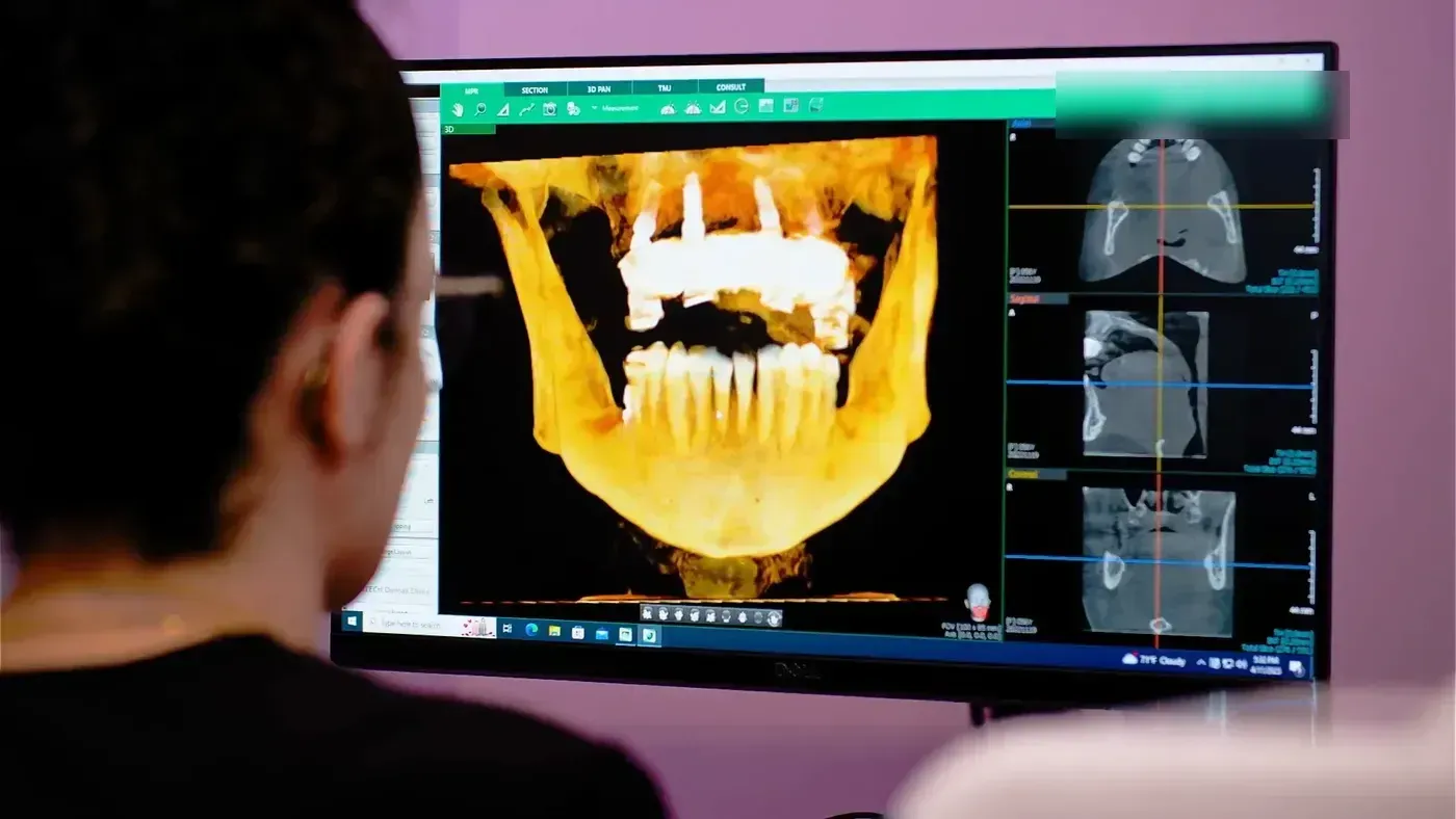 3D cone beam CT scan of a jaw on screen, showing the bone width checked before ridge splitting
