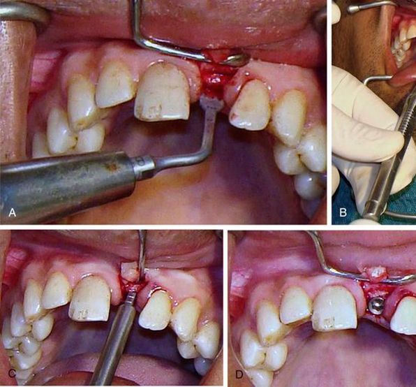 Ridge Splitting Treatment