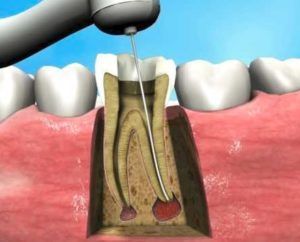 Robbinsville-Endo-Endodontics-Endodontist-Root-Canal-therapy