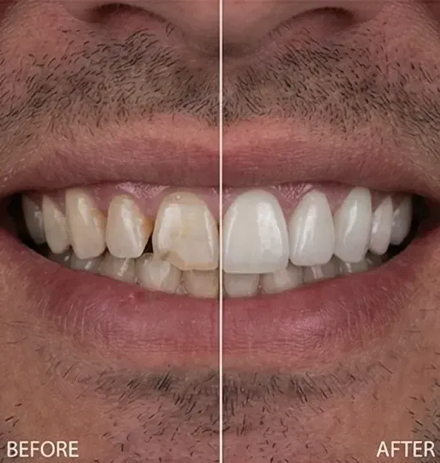 Before and after porcelain veneers: stained, chipped front teeth made bright and even, an anticipated result