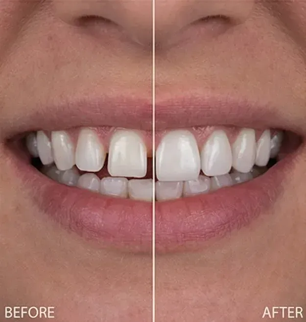 Before and after porcelain veneers: uneven, discolored front teeth made even and bright, an anticipated result