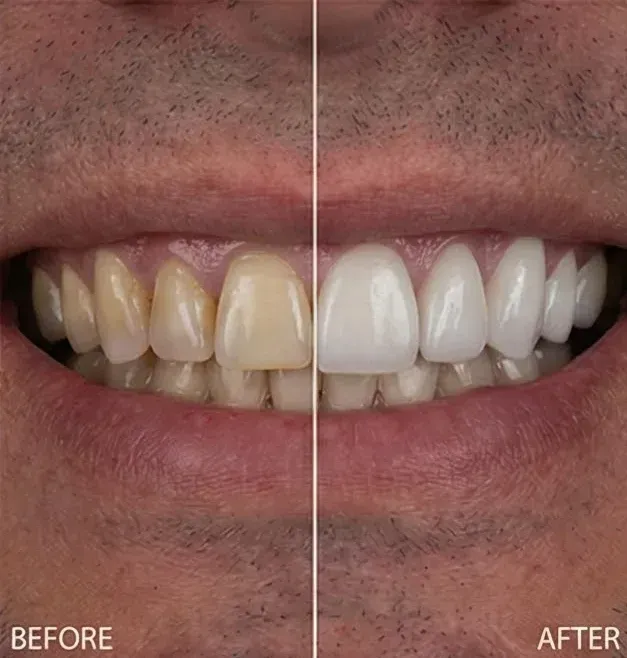 Before and after porcelain veneers turning yellow-stained front teeth bright white