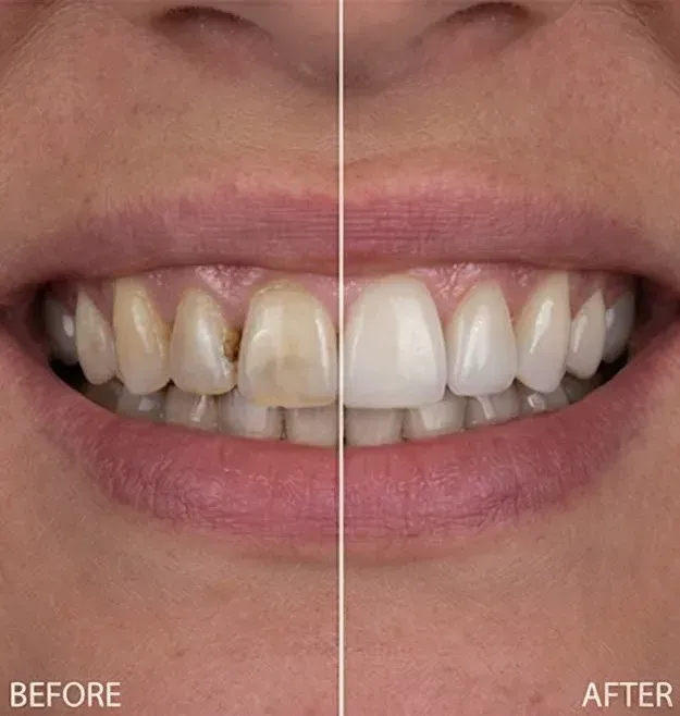 Before and after porcelain veneers covering yellowed front teeth with brown stains between them with a bright, even shade