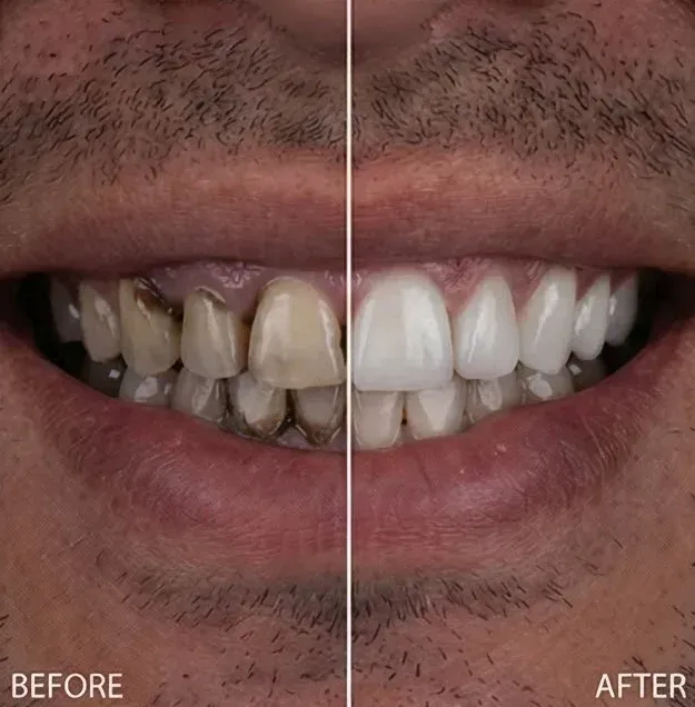 Before and after porcelain veneers replacing heavily stained, darkened front teeth with a clean white smile