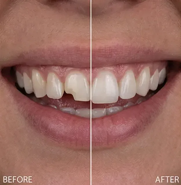 Veneers before and after: a broken front tooth edge restored to match its neighbor with a porcelain veneer